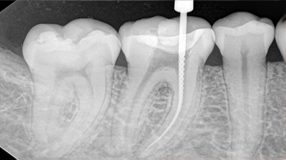 root-canal-xray-pic
